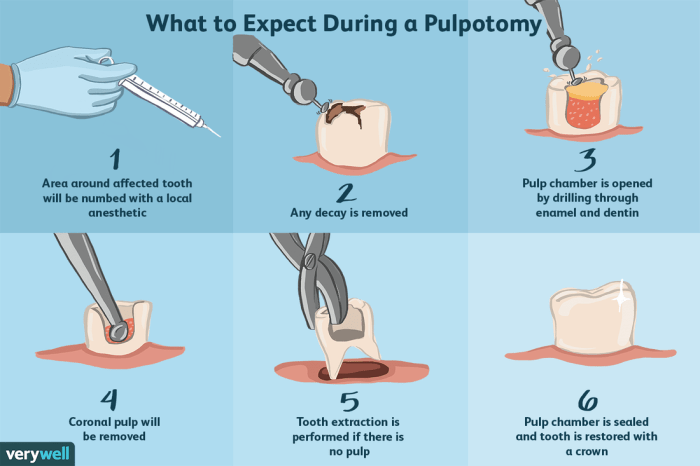 Pulpal debridement vs root canal