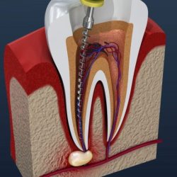 Pulpal debridement vs root canal