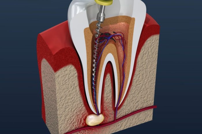 Pulpal debridement vs root canal